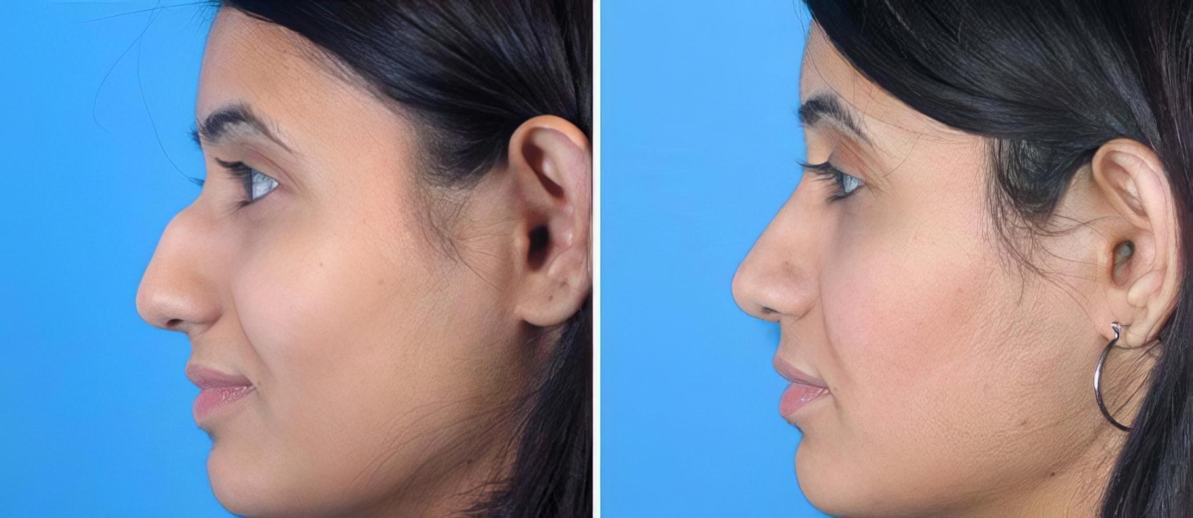Before & After Rhinoplasty Case 17688 View #2 View in Atlanta, GA