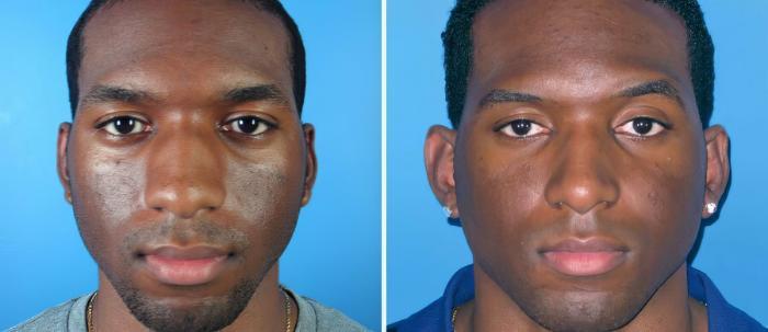 Before & After Rhinoplasty Case 17691 View #1 View in Alpharetta, GA