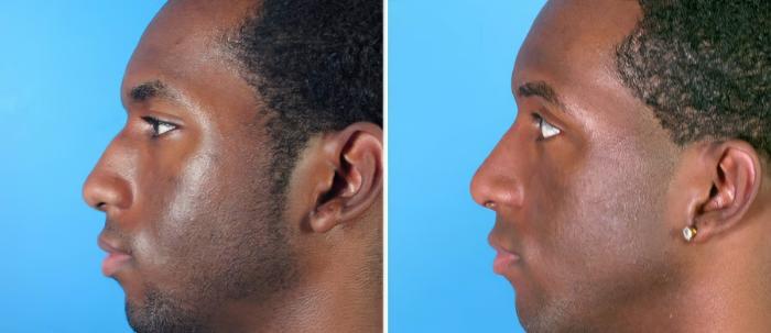 Before & After Rhinoplasty Case 17691 View #2 View in Alpharetta, GA