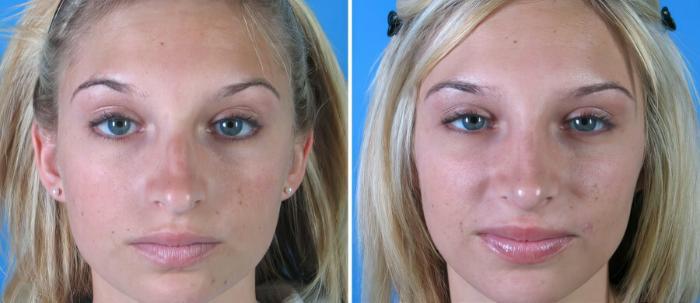 Before & After Rhinoplasty Case 18172 View #1 View in Alpharetta, GA