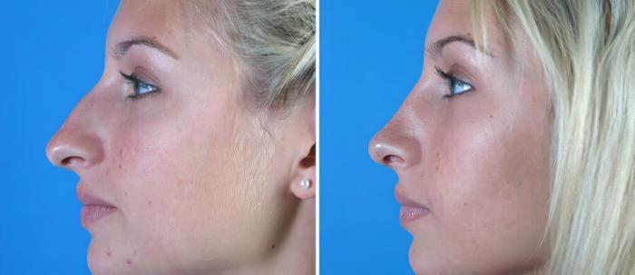 Before & After Rhinoplasty Case 18172 View #2 View in Alpharetta, GA