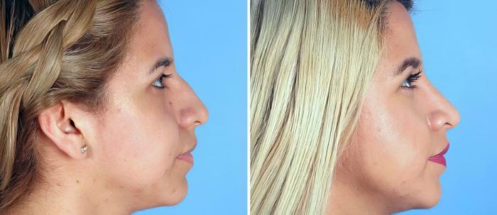 Before & After Rhinoplasty Case 19266 View #2 View in Alpharetta, GA