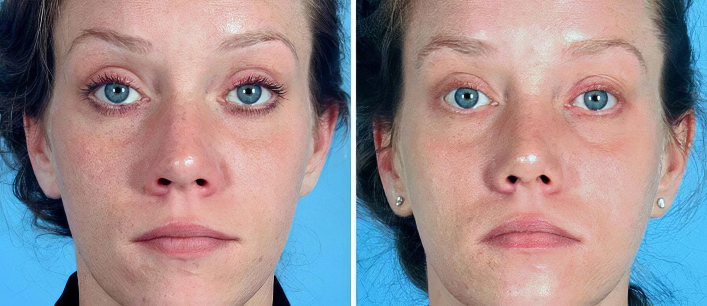 Before & After Rhinoplasty Case 19269 View #1 View in Alpharetta, GA