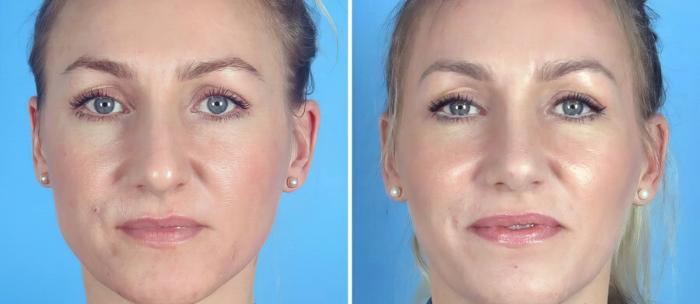 Before & After Rhinoplasty Case 19396 View #1 View in Alpharetta, GA