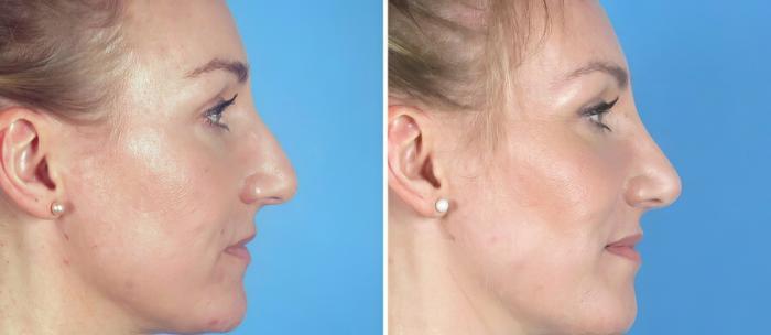 Before & After Rhinoplasty Case 19396 View #2 View in Alpharetta, GA