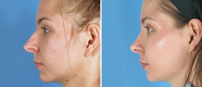 Before & After Rhinoplasty Case 19399 View #2 View in Alpharetta, GA