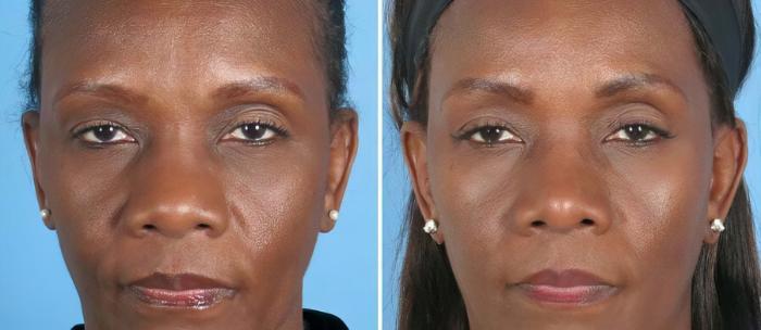 Before & After Rhinoplasty Case 19402 View #1 View in Alpharetta, GA