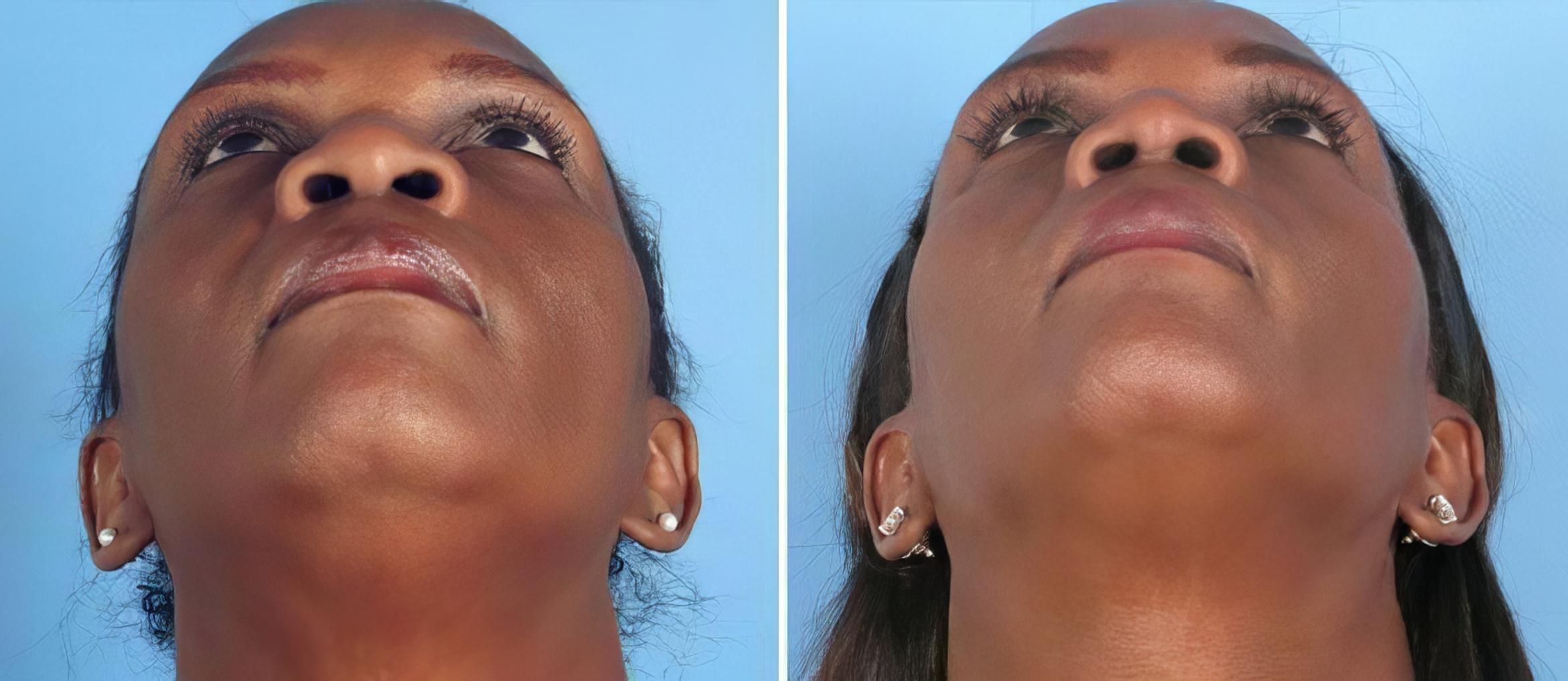 Before & After Rhinoplasty Case 19402 View #2 View in Atlanta, GA