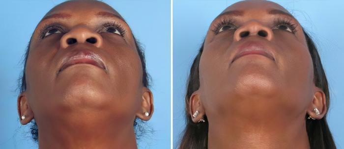 Before & After Rhinoplasty Case 19402 View #2 View in Alpharetta, GA