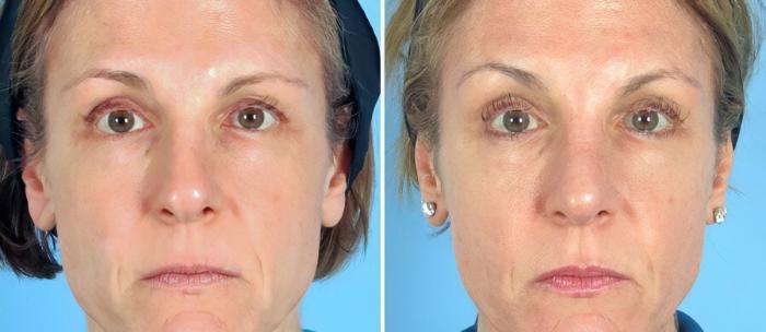 Before & After Rhinoplasty Case 19405 View #1 View in Alpharetta, GA