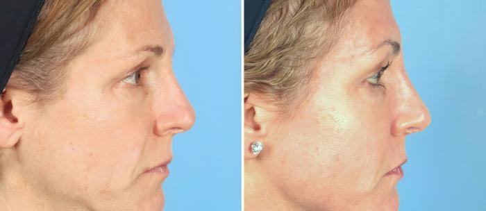 Before & After Rhinoplasty Case 19405 View #2 View in Alpharetta, GA