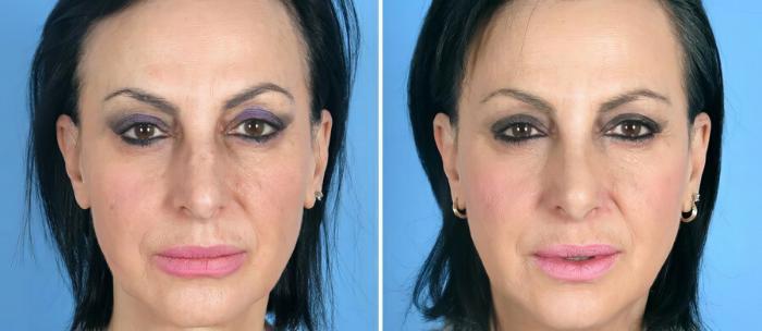 Before & After Rhinoplasty Case 19413 View #1 View in Alpharetta, GA