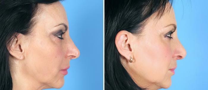 Before & After Rhinoplasty Case 19413 View #2 View in Alpharetta, GA