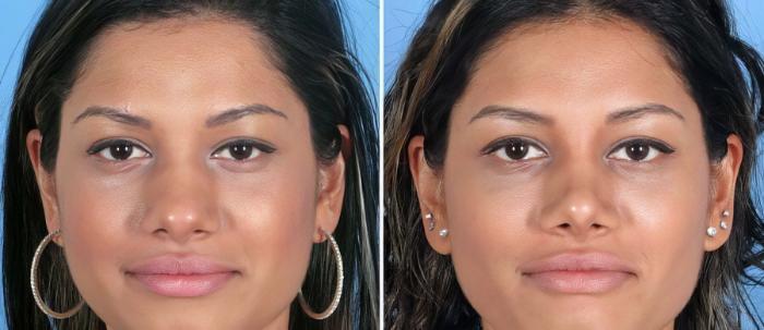 Before & After Rhinoplasty Case 19416 View #1 View in Alpharetta, GA
