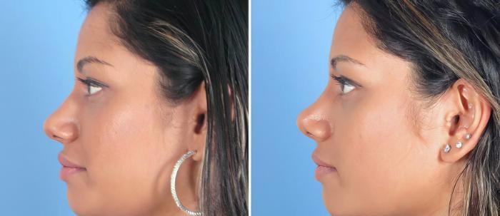 Before & After Rhinoplasty Case 19416 View #2 View in Alpharetta, GA