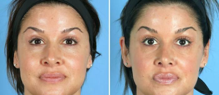 Before & After Rhinoplasty Case 19419 View #1 View in Alpharetta, GA
