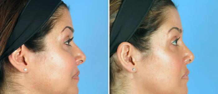 Before & After Rhinoplasty Case 19419 View #2 View in Alpharetta, GA