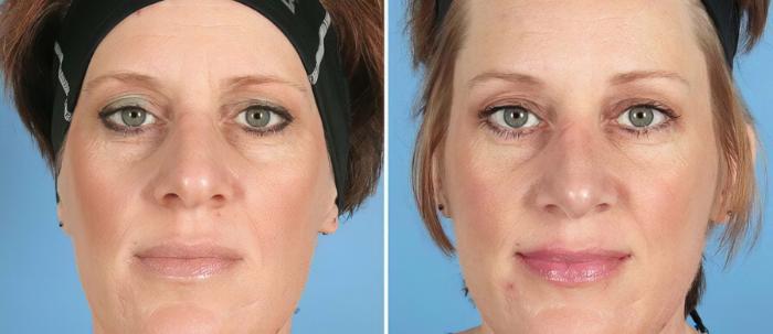 Before & After Rhinoplasty Case 19422 View #1 View in Alpharetta, GA