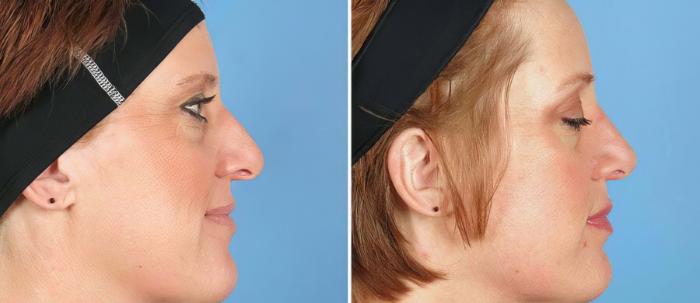 Before & After Rhinoplasty Case 19422 View #2 View in Alpharetta, GA