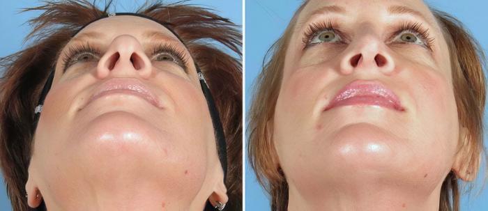 Before & After Rhinoplasty Case 19422 View #3 View in Alpharetta, GA