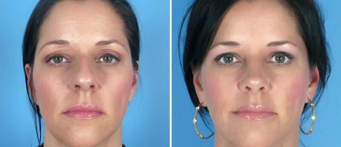 Before & After Rhinoplasty Case 25818 View #1 View in Alpharetta, GA