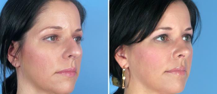 Before & After Rhinoplasty Case 25818 View #2 View in Alpharetta, GA