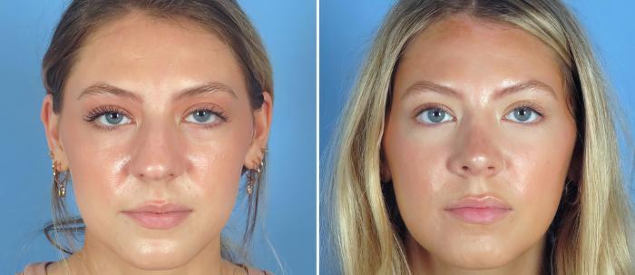 Before & After Rhinoplasty Case 26837 View #1 View in Alpharetta, GA