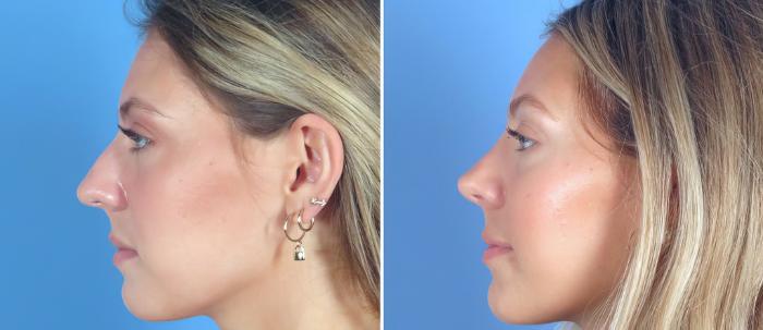 Before & After Rhinoplasty Case 26837 View #2 View in Alpharetta, GA