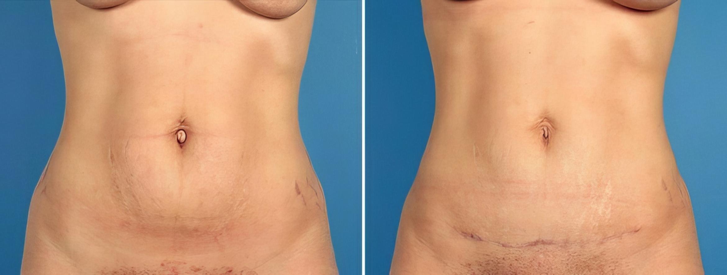 Before & After Tummy Tuck Case 16937 View #1 View in Alpharetta, GA