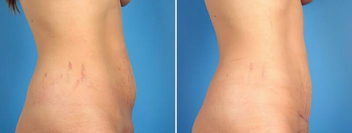 Before & After Tummy Tuck Case 16937 View #2 View in Alpharetta, GA
