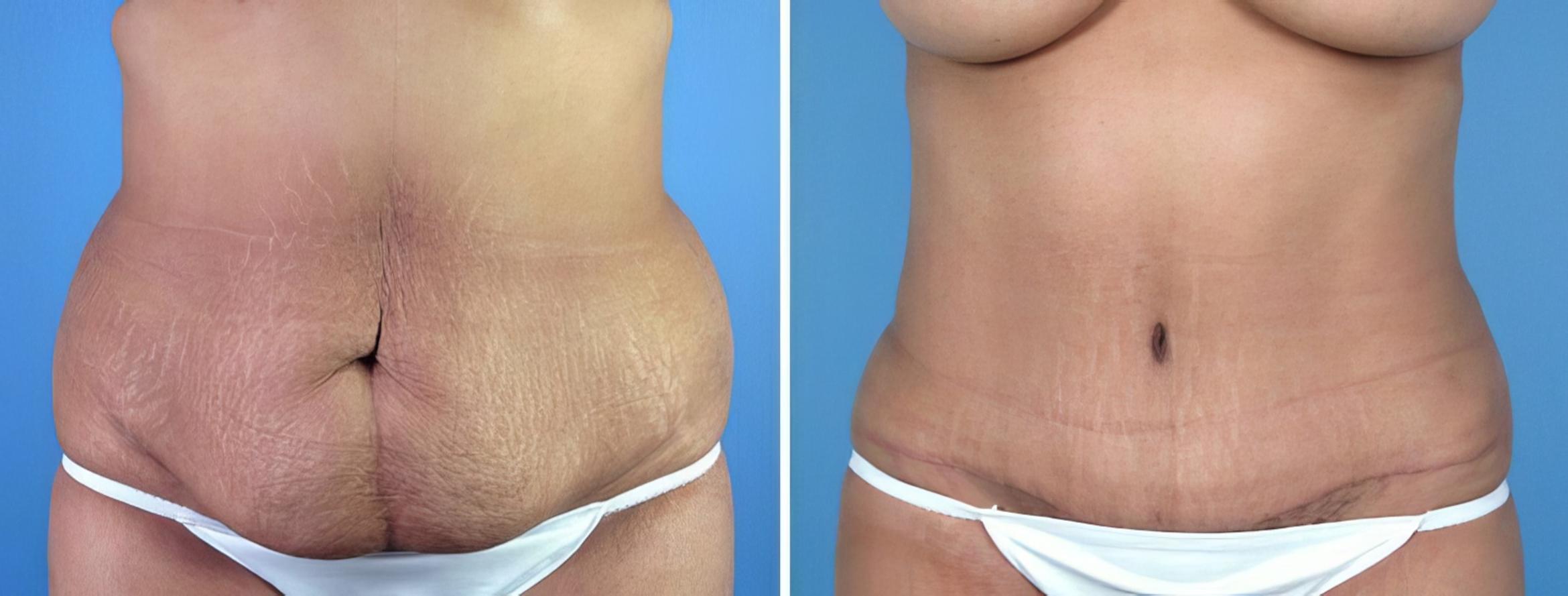 Before & After Tummy Tuck Case 16961 View #1 View in Alpharetta, GA