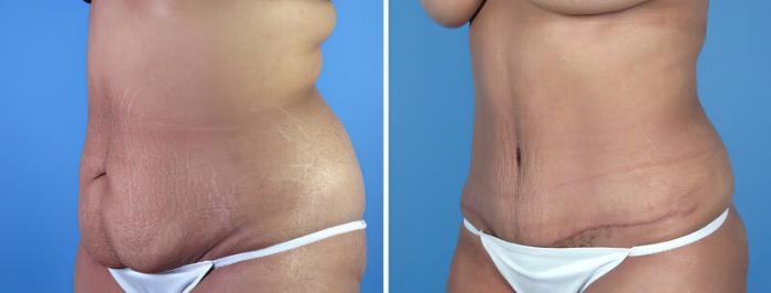 Before & After Tummy Tuck Case 16961 View #2 View in Alpharetta, GA