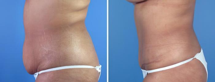 Before & After Tummy Tuck Case 16961 View #3 View in Alpharetta, GA