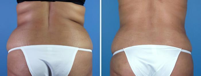 Before & After Tummy Tuck Case 16961 View #4 View in Alpharetta, GA