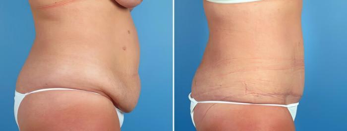 Before & After Tummy Tuck Case 16966 View #2 View in Alpharetta, GA