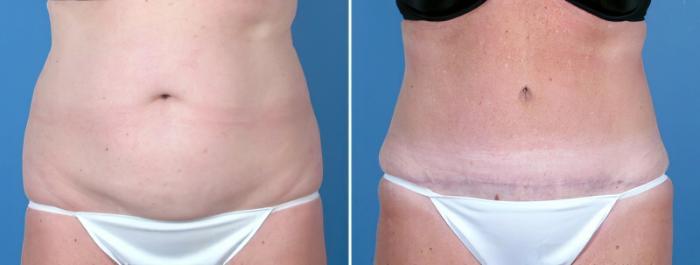 Before & After Tummy Tuck Case 16972 View #1 View in Alpharetta, GA