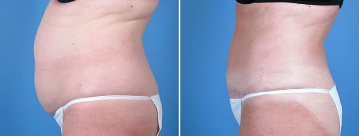 Before & After Tummy Tuck Case 16972 View #2 View in Alpharetta, GA