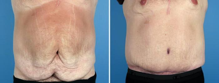 Before & After Tummy Tuck Case 17508 View #1 View in Alpharetta, GA
