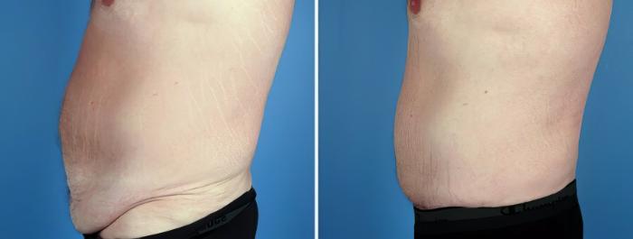 Before & After Tummy Tuck Case 17508 View #2 View in Alpharetta, GA
