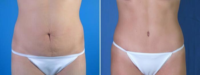 Before & After Tummy Tuck Case 17874 View #2 View in Alpharetta, GA