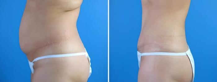 Before & After Tummy Tuck Case 17918 View #2 View in Alpharetta, GA