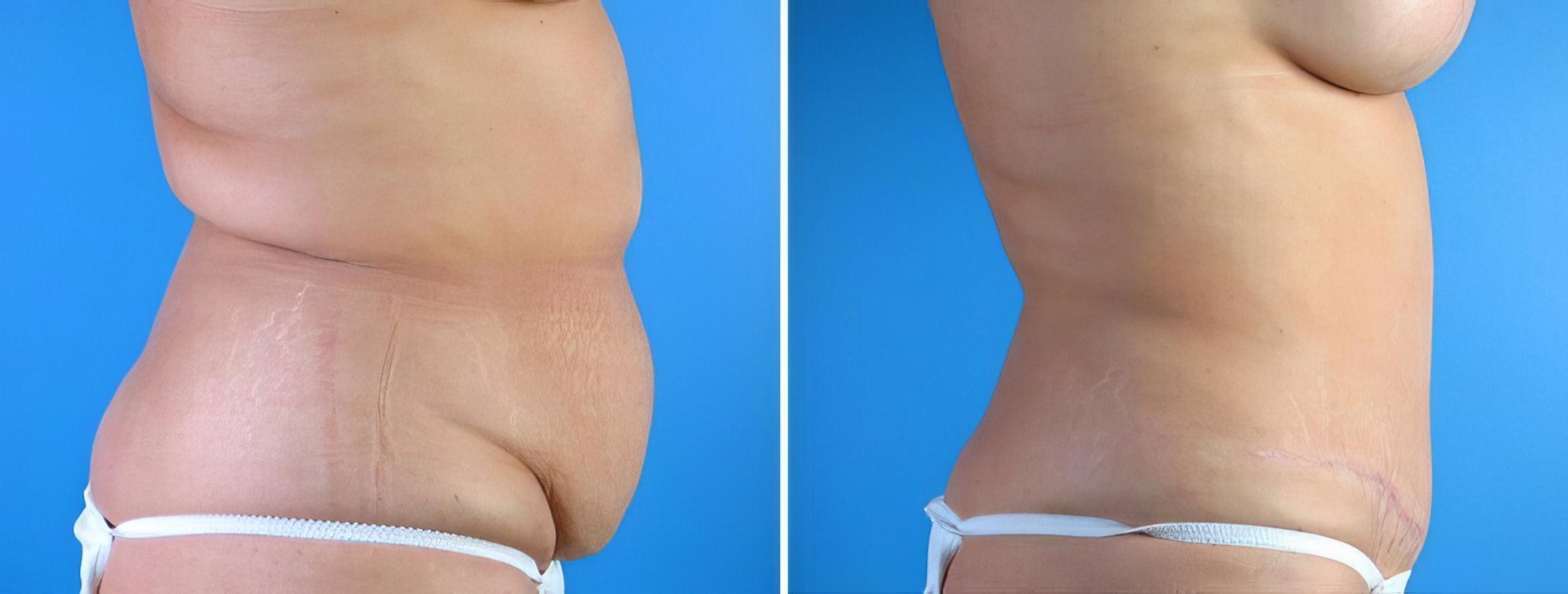 Before & After Tummy Tuck Case 17921 View #1 View in Alpharetta, GA