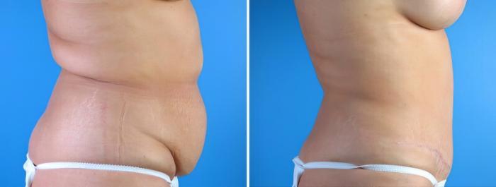 Before & After Tummy Tuck Case 17921 View #1 View in Alpharetta, GA