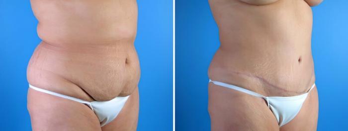 Before & After Tummy Tuck Case 17921 View #2 View in Alpharetta, GA