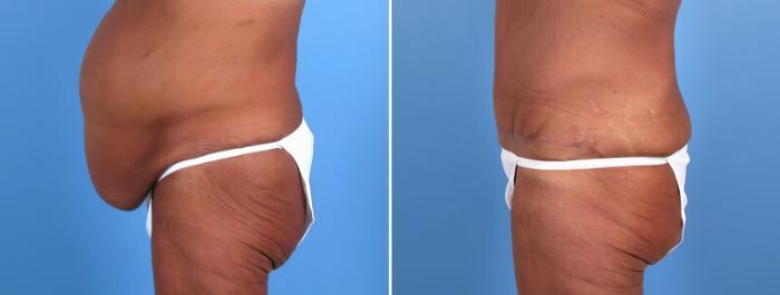 Before & After Tummy Tuck Case 18105 View #2 View in Alpharetta, GA