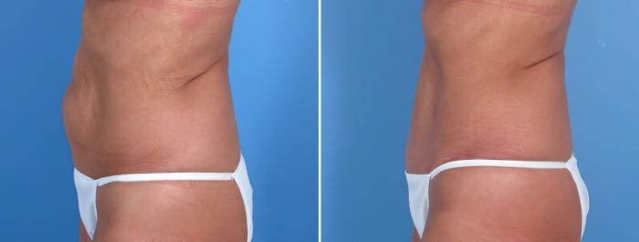 Before & After Tummy Tuck Case 18111 View #1 View in Alpharetta, GA