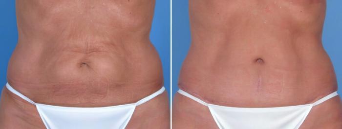 Before & After Tummy Tuck Case 18111 View #2 View in Alpharetta, GA