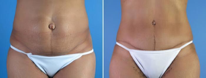 Before & After Tummy Tuck Case 18117 View #1 View in Alpharetta, GA