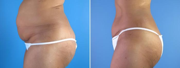 Before & After Tummy Tuck Case 18117 View #2 View in Alpharetta, GA
