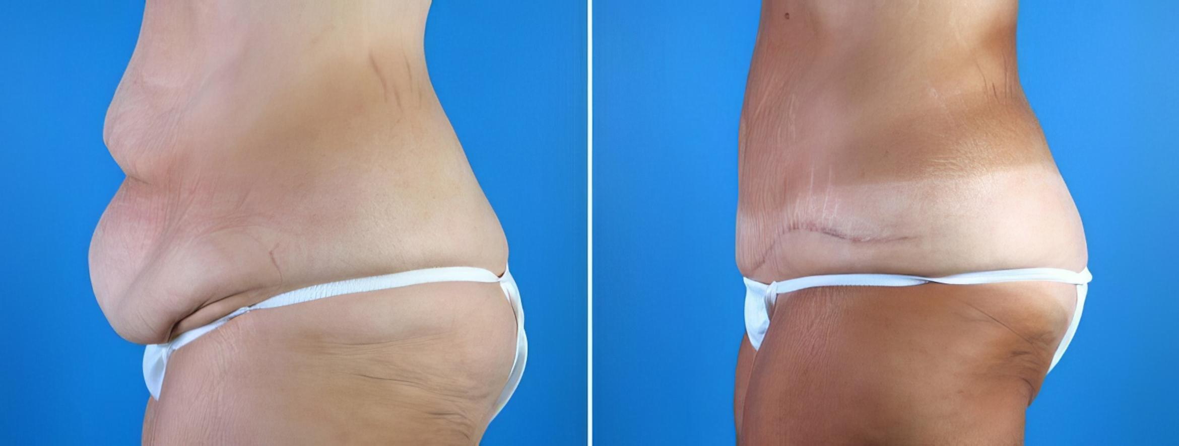 Before & After Tummy Tuck Case 18120 View #1 View in Alpharetta, GA
